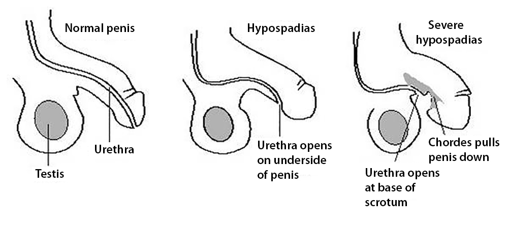 Hypospadias Overview
