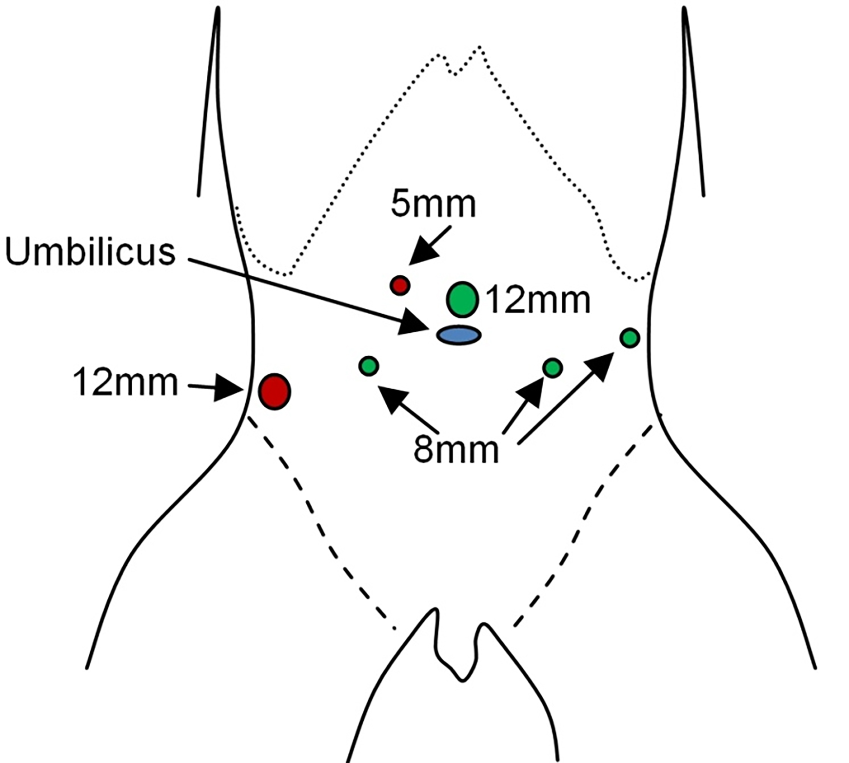 Radical Prostatectomy Surgery